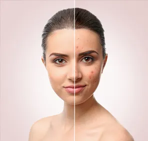 Acne Cleanup at parlour - a close-up of a woman's face showing clear skin on one half and acne on the other half.
