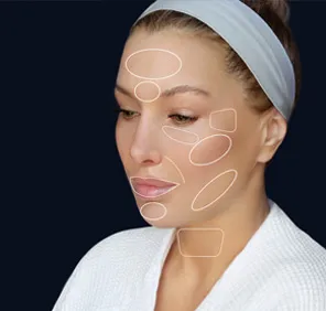 Anti-aging treatment in Hyderabad. Woman's face with circles highlighting areas where dermal fillers can be used for anti-aging treatment.
