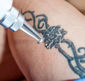 Tattoo removal at a skin and hair clinic.
