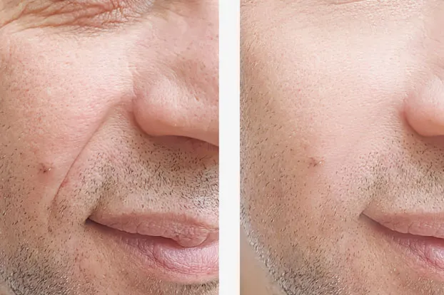 An old man's cheek is compared to a young man's cheek to portray the benefits of anti aging treatment in Hyderabad.
