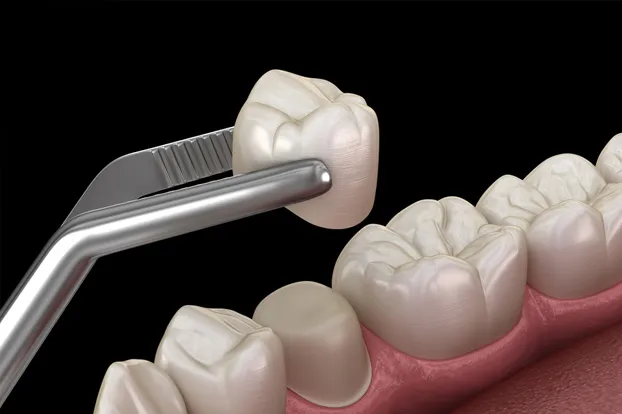Fix cracked tooth crown with a new dental crown.

