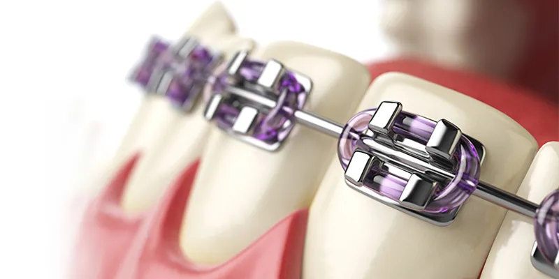Metallic braces on teeth
