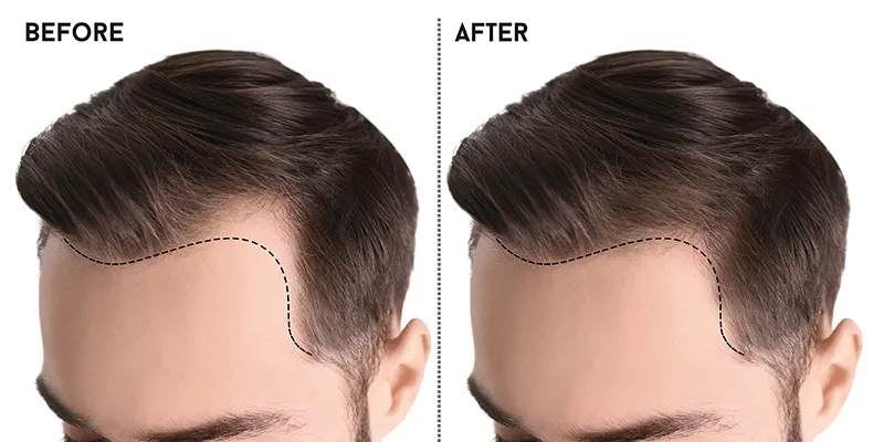 Hair rejuvenation with PRP - PRP results before and after.