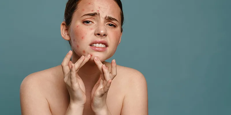 Young girl with pimples on her face - why acne and pimples are common in adolescence.