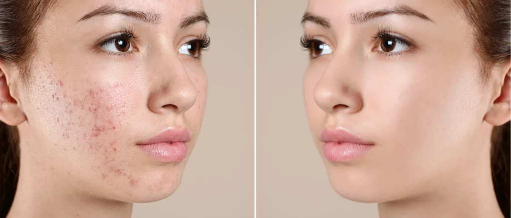 Girl's face with blemish-prone skin and with clear skin.