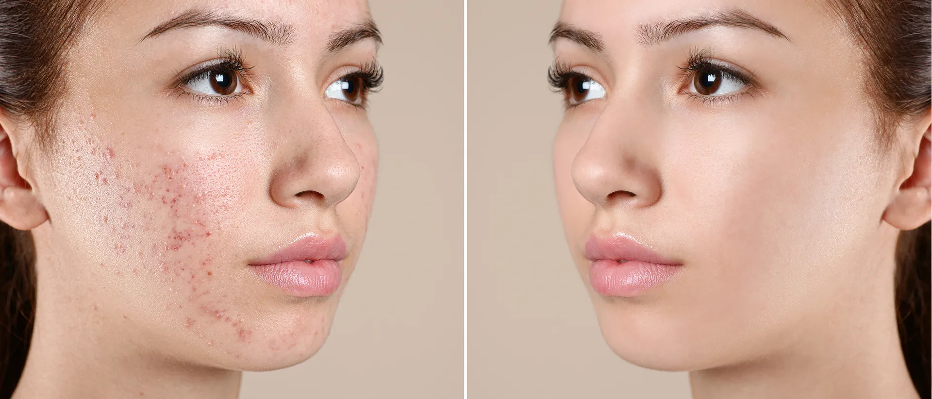 Girl's face with blemish-prone skin and with clear skin.