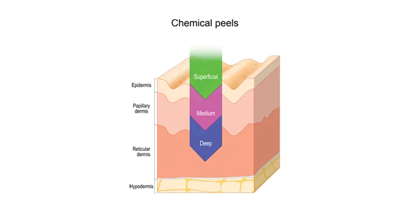 Chemical peels : Superficial, Medium-depth peel or a Deep peel.