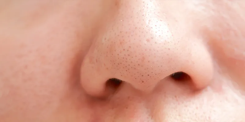 Types of skin blemishes - woman's nose with blackheads.