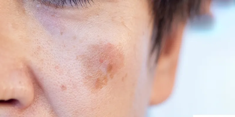 Close up of man's face with blemish-prone skin.
