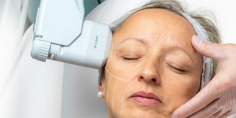 Woman getting a HiFU facial to look younger.