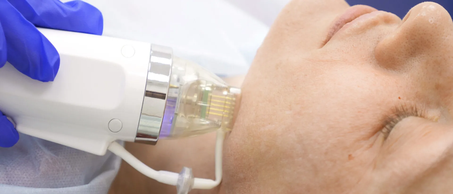 Laser therapy for skin resurfacing
