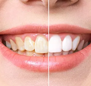 Teeth scaling and polishing at a dental care clinic.
