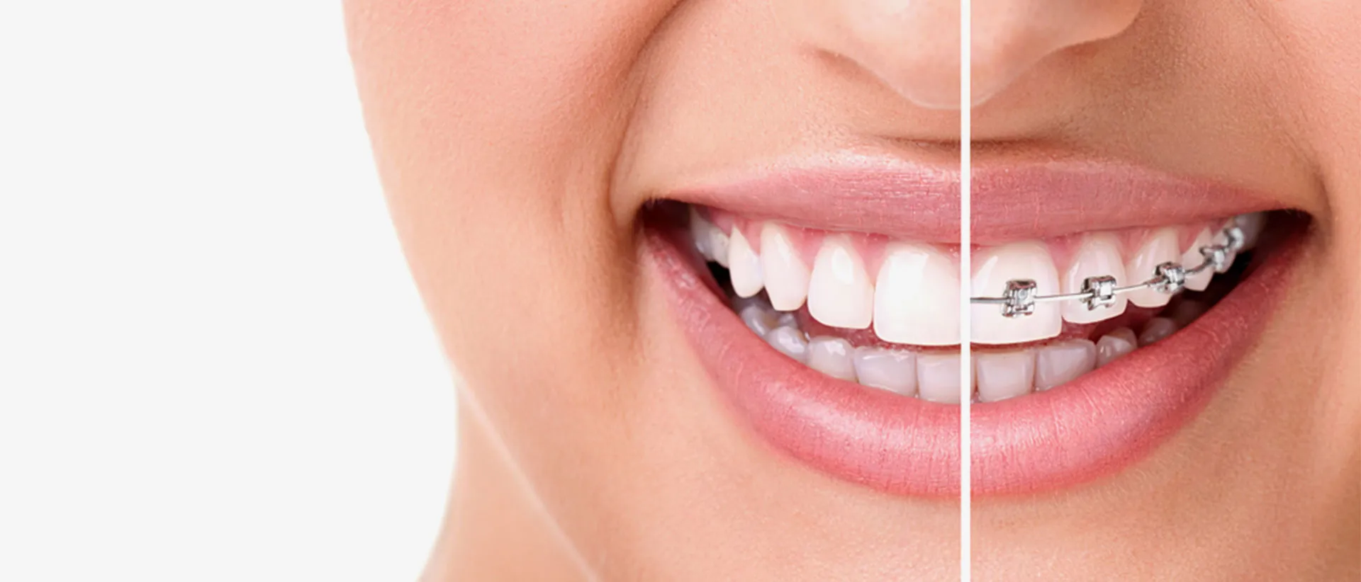 Girl with a beautiful smile - Braces help fix crooked and slanted teeth.
