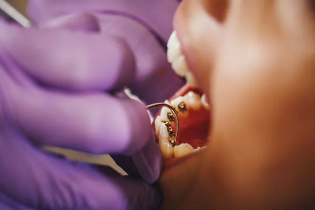 Braces treatment at a braces dental clinic
