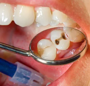 A dental tool spots cavities through the black teeth.
