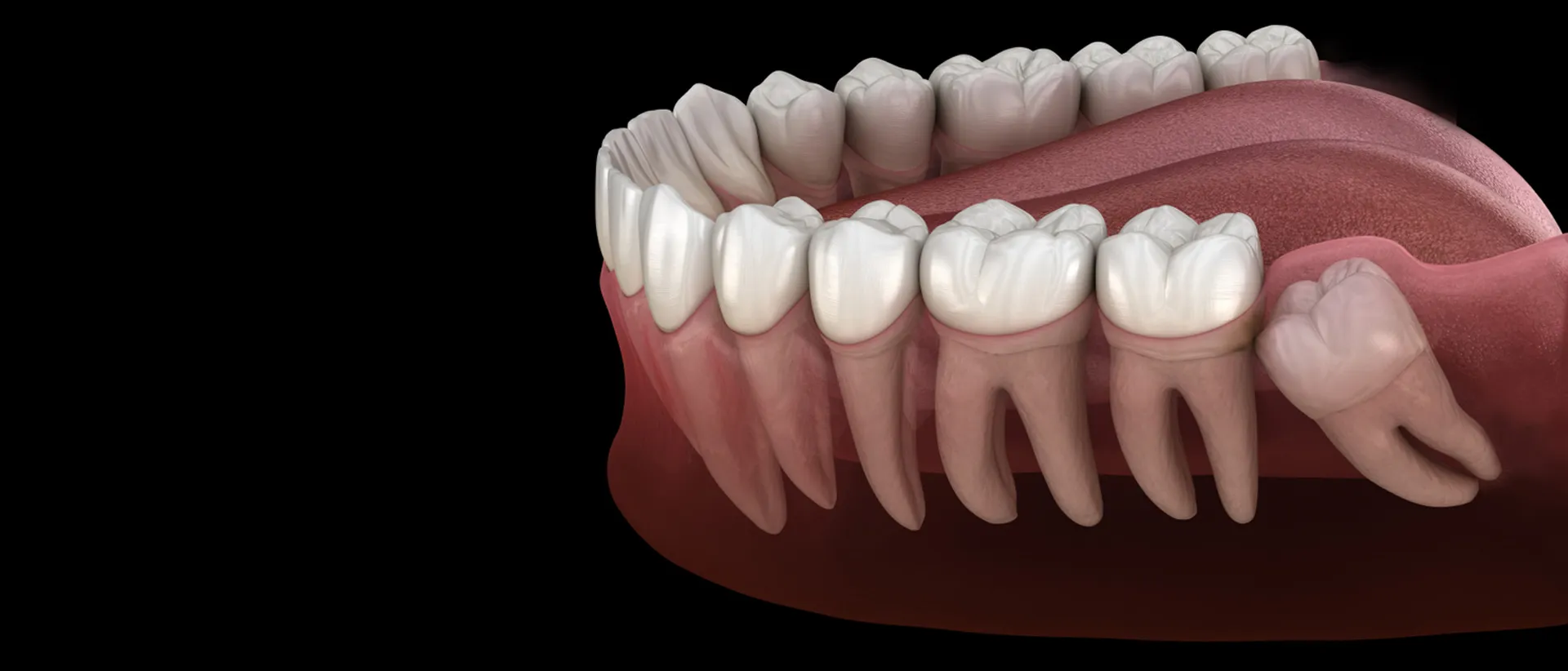 An illustration of white teeth indicates a horizontal impacted wisdom tooth.
