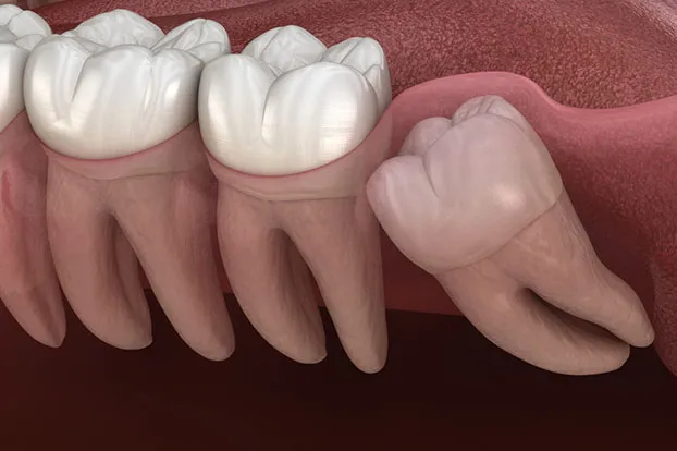 A mesial impaction was illustrated at a dental clinic in Hyderabad with two straight teeth and one tooth underneath the gums.
