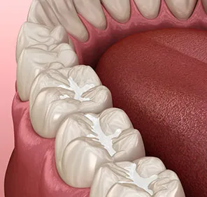 A set of white teeth that explain cavity restoration by a dentist in Hyderabad.
