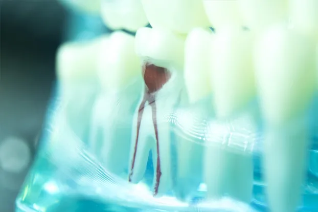 An infected or damaged tissue inside the tooth that needs a root canal treatment.
