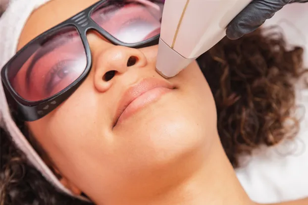 Woman getting laser treatment for upper lip.

