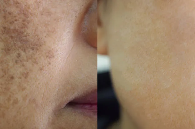 Melasma - hyperpigmentation laser treatment - pigmented skin and normal skin.
            