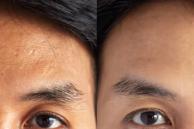 Improvement in skin after skin whitening and brightening treatment.
