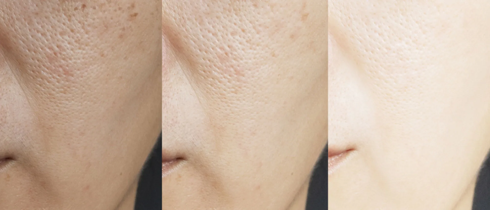 Radiant and luminous skin after whitening and brightening treatment.
