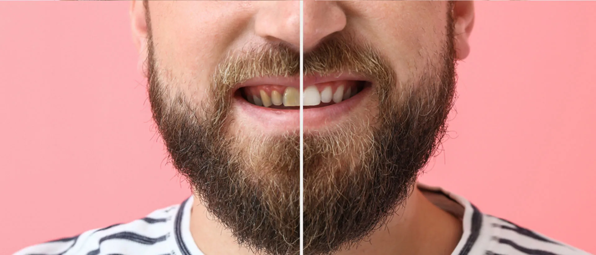Man’s face before and after teeth scaling and polishing
