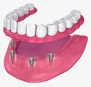 Metallic fillings of implant supported dentures.

