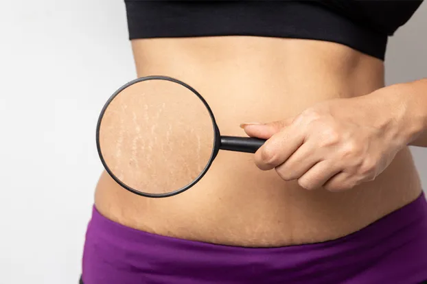 Stretch marks removal treatment  - woman holding a magnifying glass showing her stretch marks.
